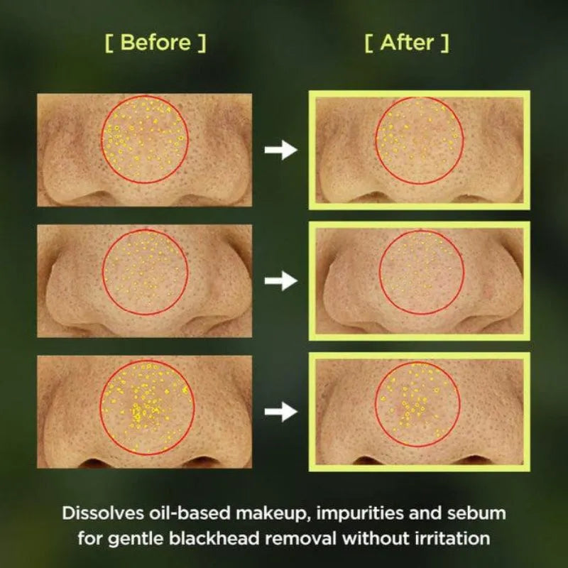 [Anua] Huile Nettoyante Contrôle de Pores Heartleaf